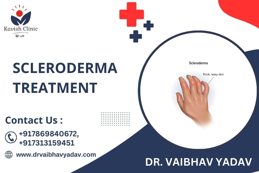 Scleroderma Treatment In Indore