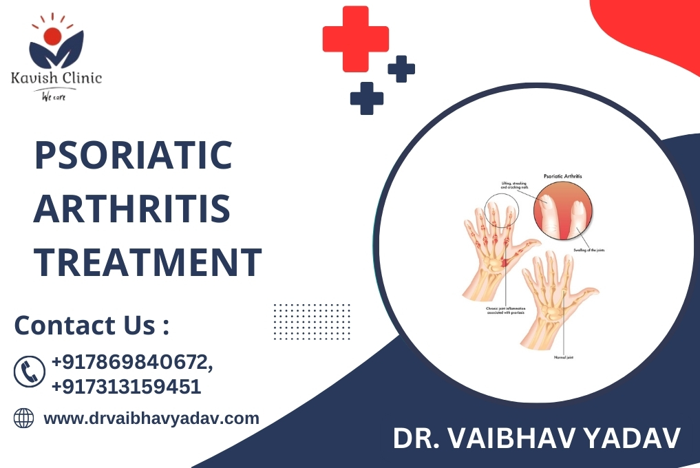 Psoriatic Arthritis Treatment Specialist In Indore