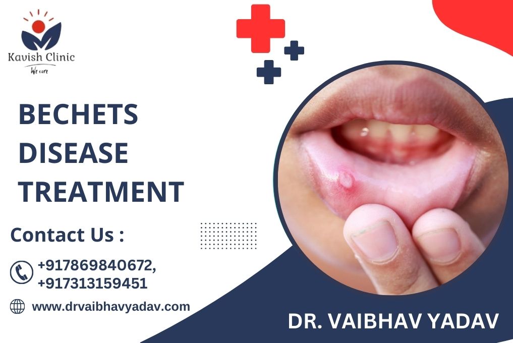 Behcets Disease Treatment Specialist in Indore