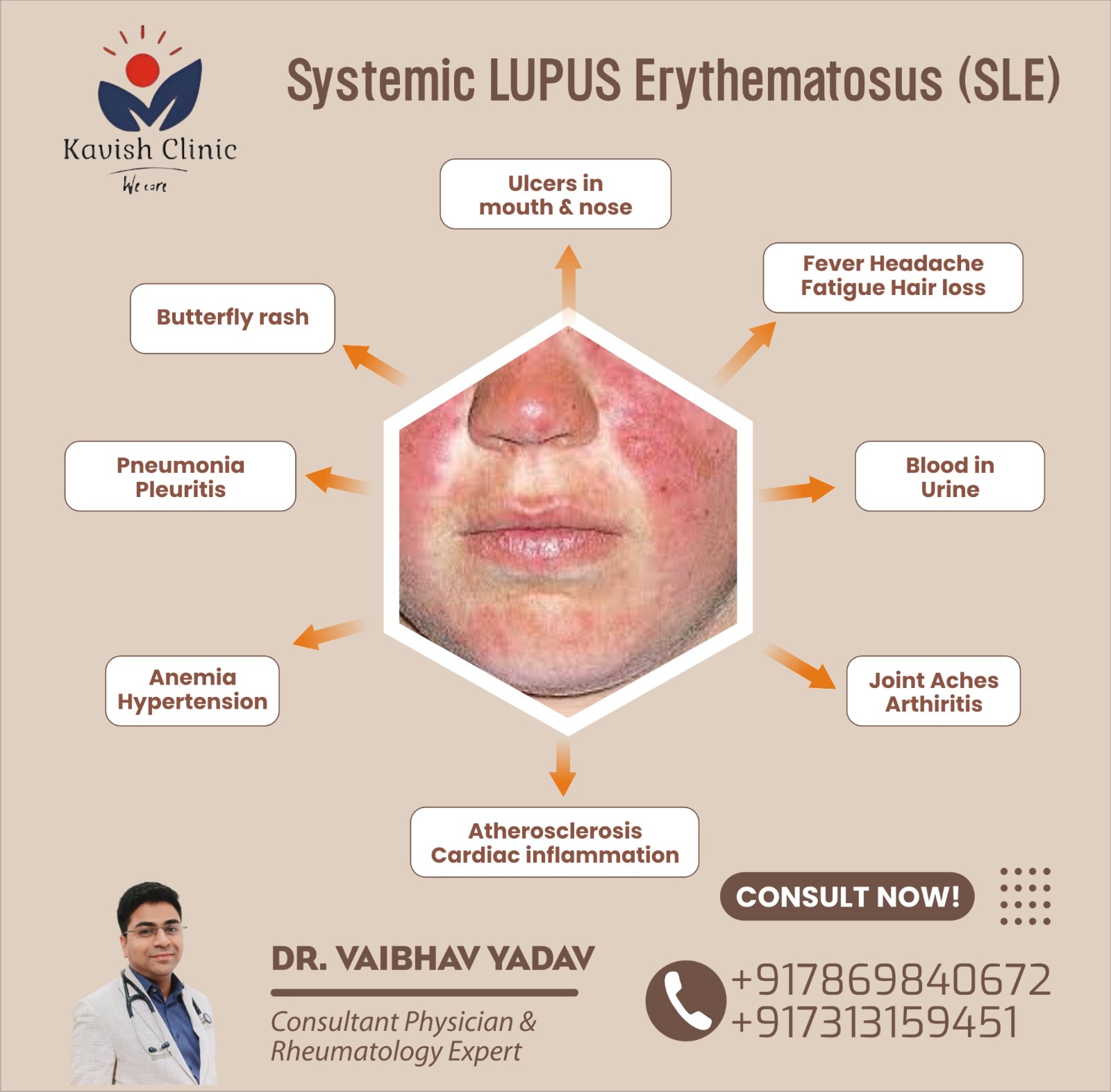 Best Doctor for Lupus Nephritis Treatment In Indore