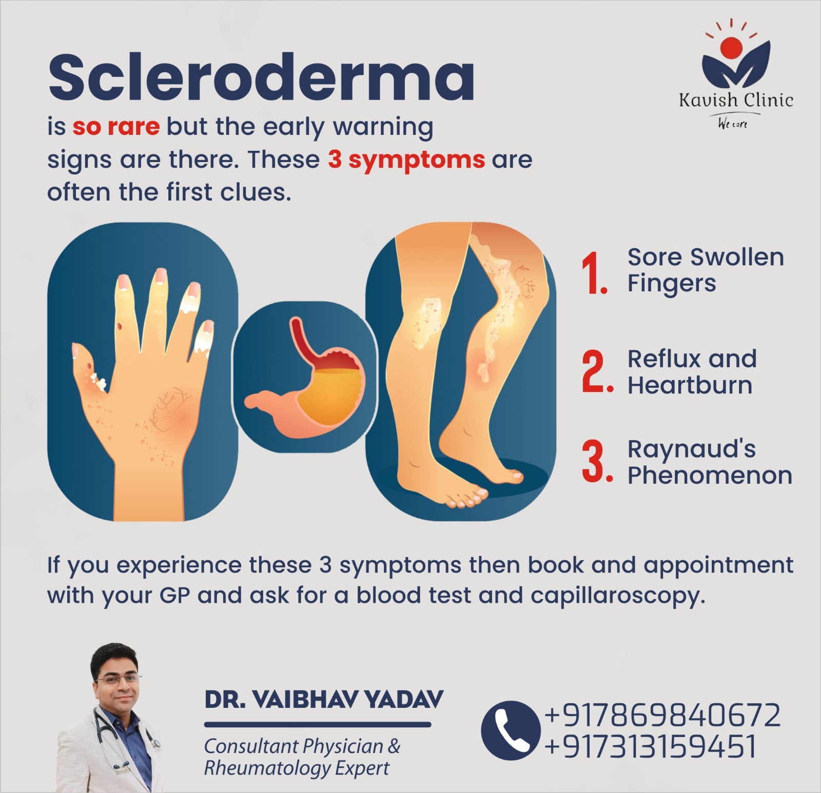 Best Doctor for Scleroderma Treatment in Indore