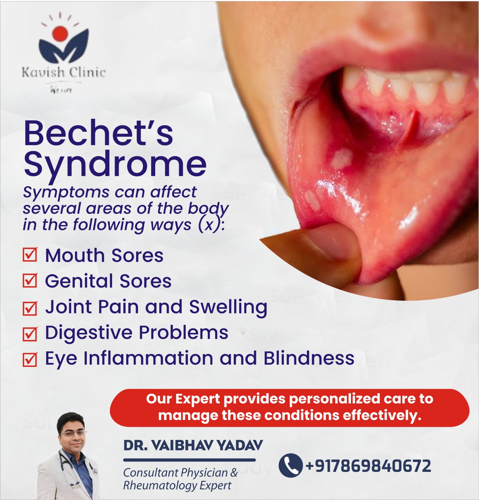 Best Doctor for Bachets Syndrome in Indore