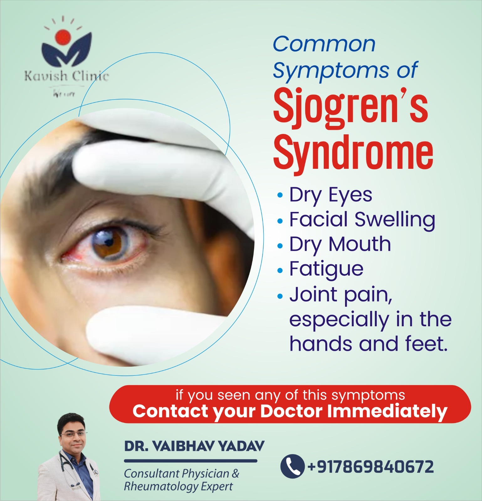 Best Doctor for Sjogrens Syndrome Treatment in Indore