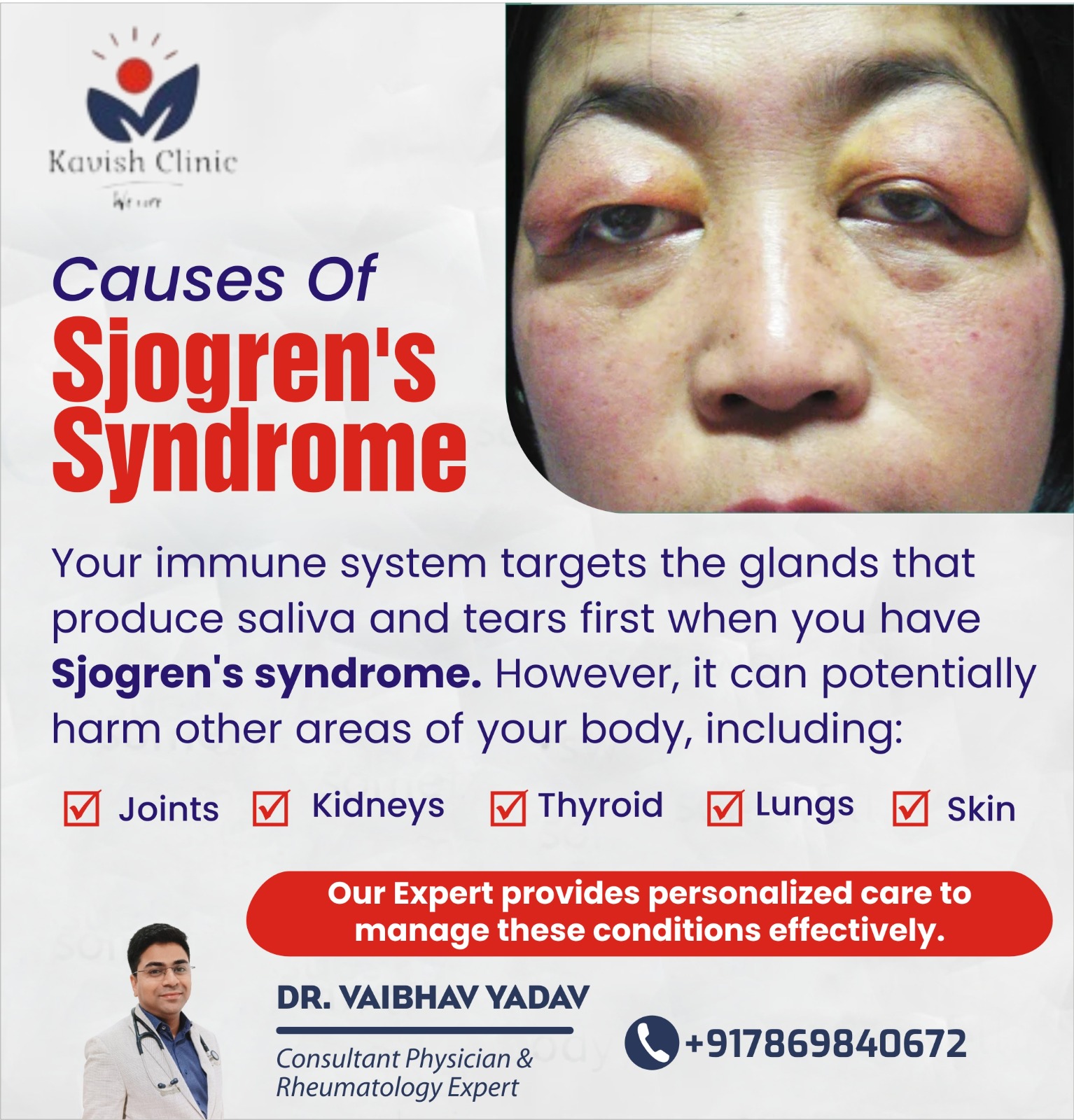 Sjogren syndrome Specialist Near Vijay Nagar in Indore MP
