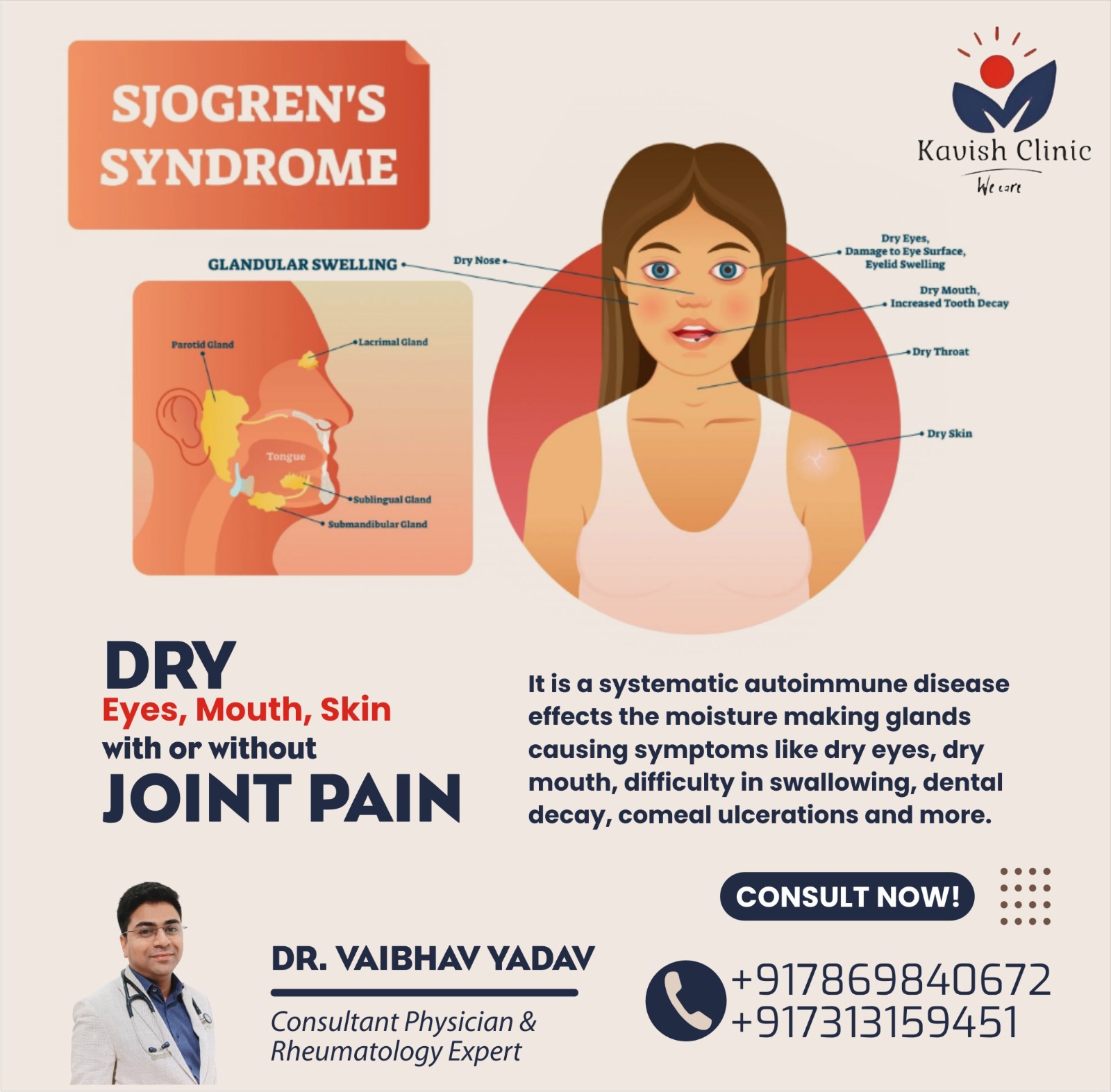 Best Doctor for Sjogren Syndrome Treatment in Indore