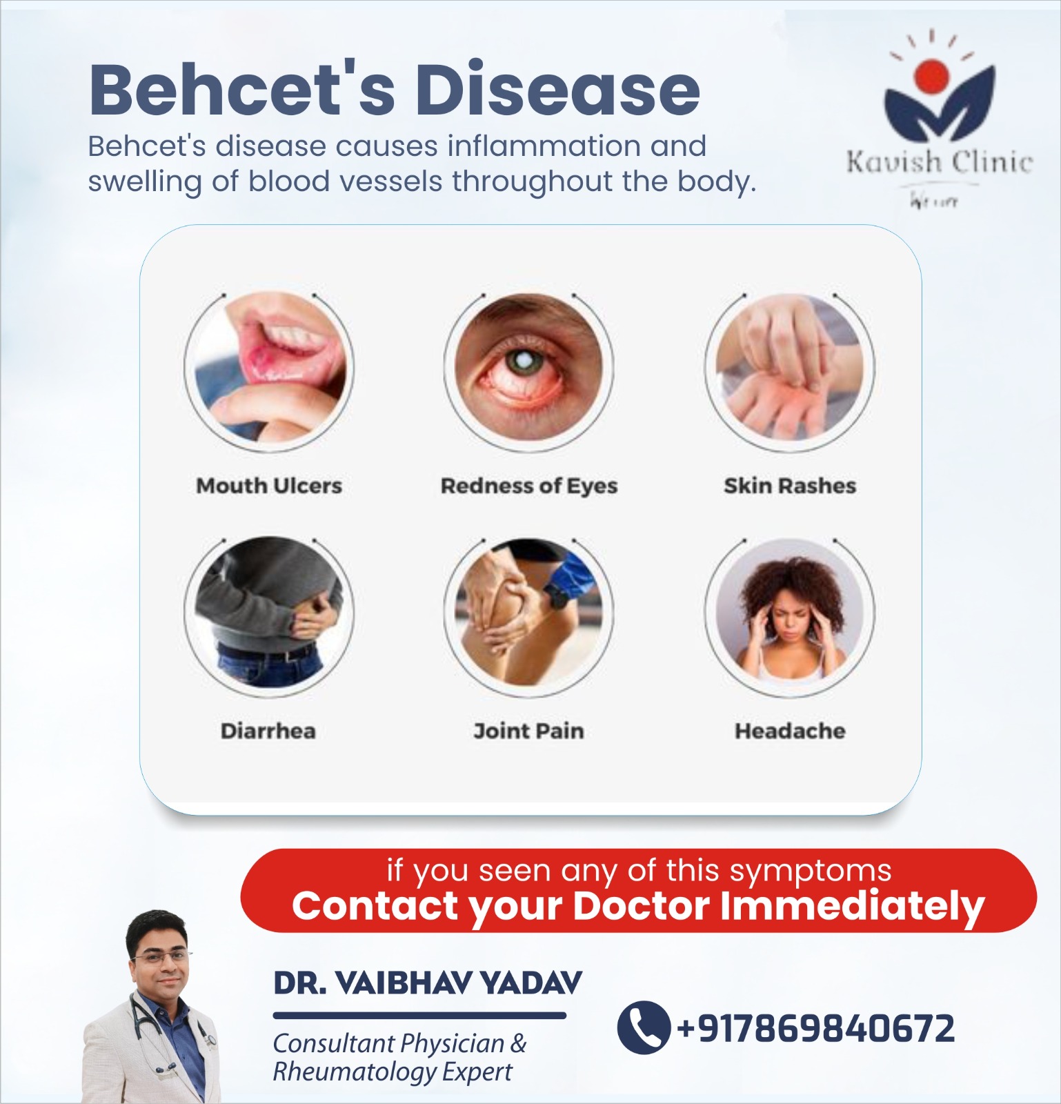 Best Doctor for Behcets Disease in Indore 