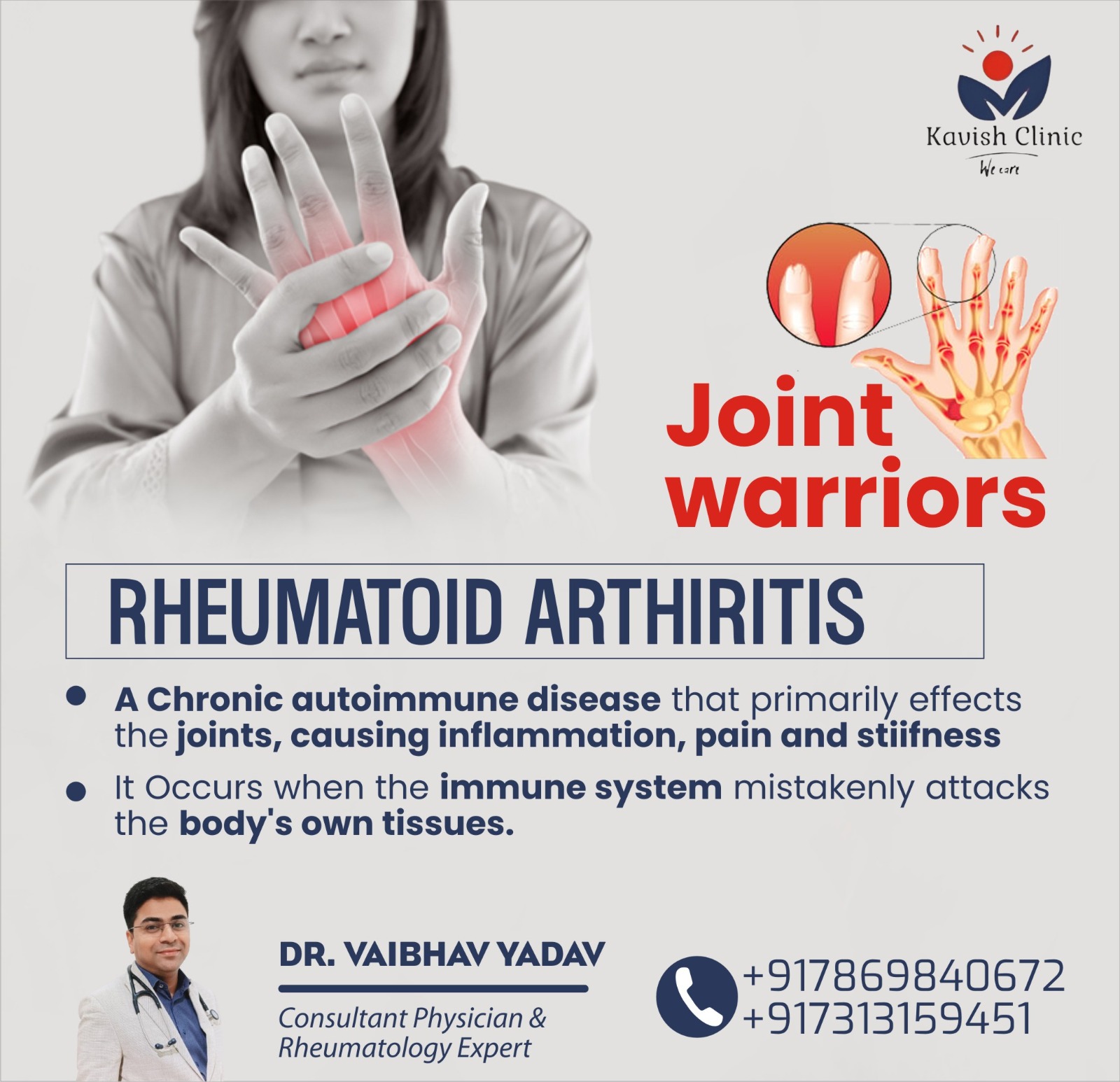 Best Doctor for Rheumatoid Arthritis Treatment in Indore