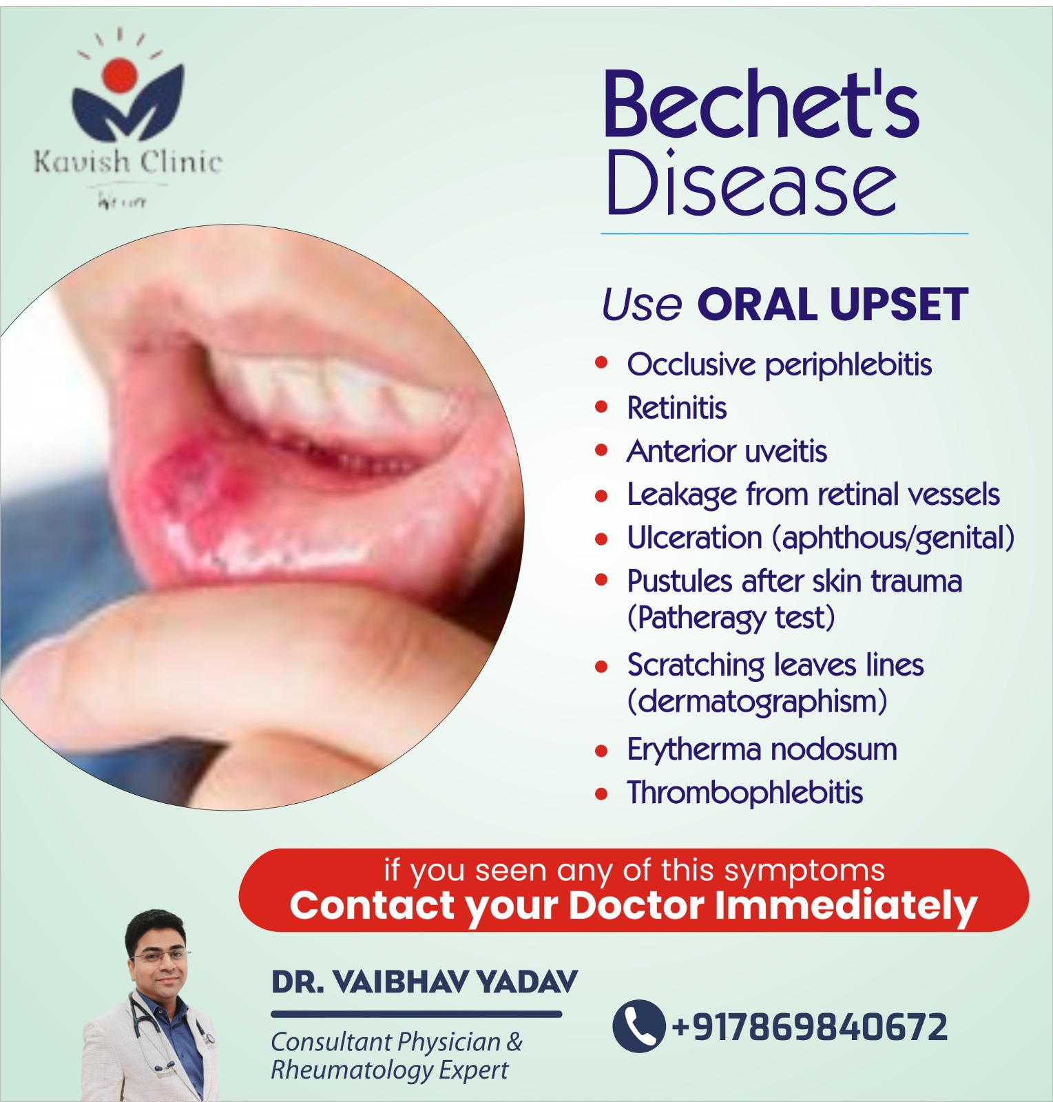 Best Doctor for Behcets Disease Treatment in Indore 
