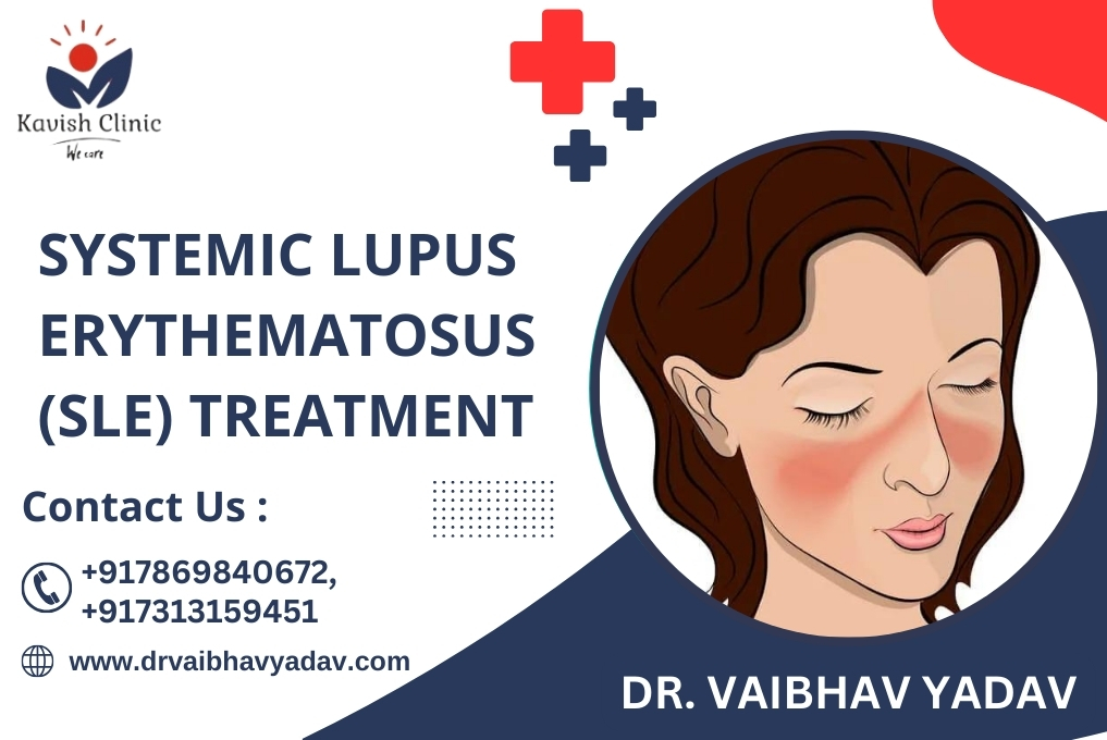 Best Systemic Lupus Erythematosus Specialist in Indore